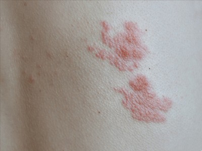 性病性淋巴肉芽腫套圖 (50) 