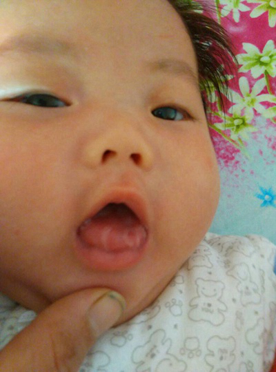 寶寶鵝口瘡 (70) 