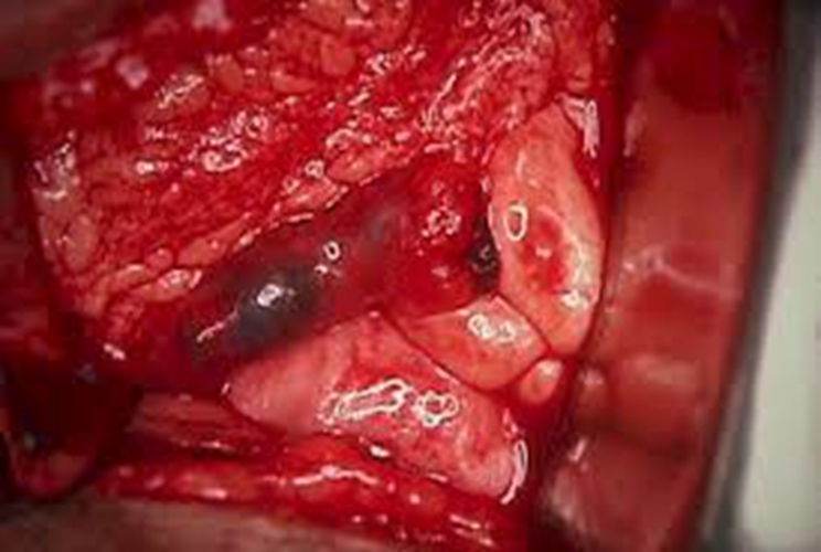 早孕藥流排出孕囊