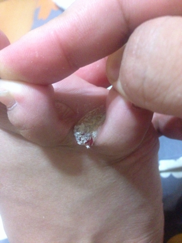 真菌性腳蘚的