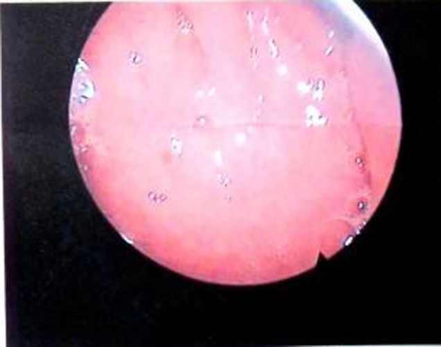 早期鼻腔慢性鼻炎