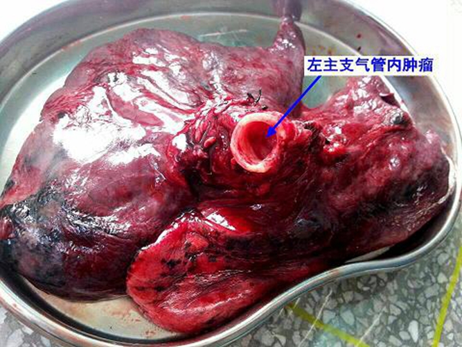 肺腺癌左肺全切