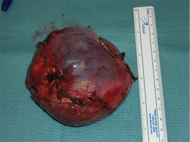 已切除的腎上腺腫瘤