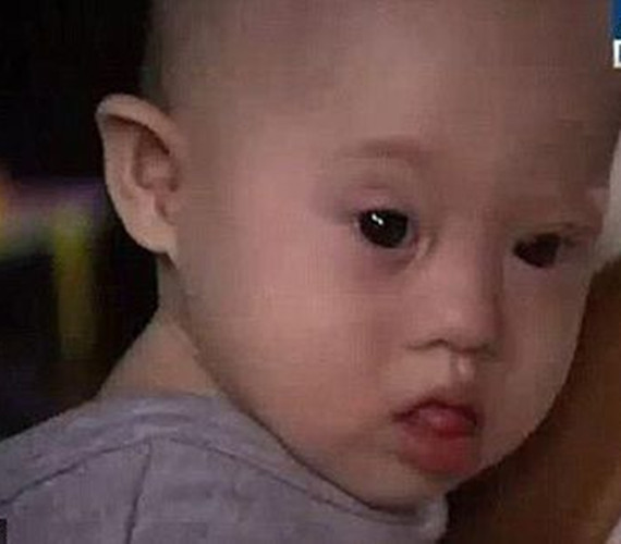 小兒唐氏綜合症