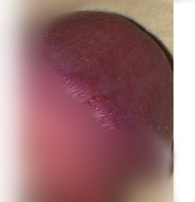 尿道口紅腫 (43) 