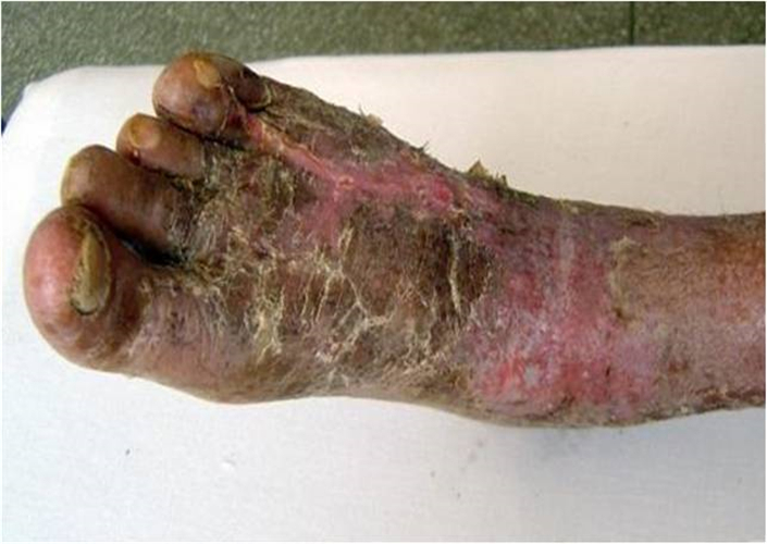 嚴重的糖尿病足
