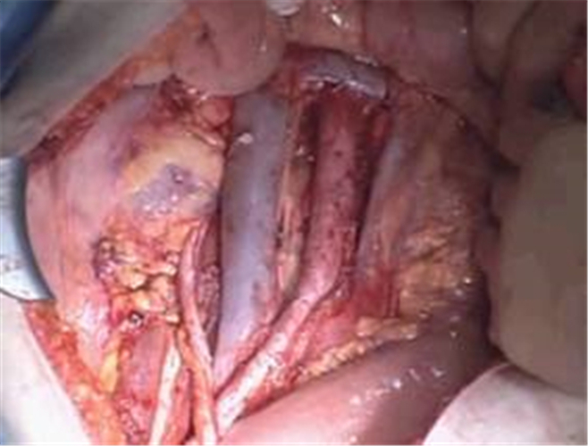 卵巢癌腫瘤細胞減滅術