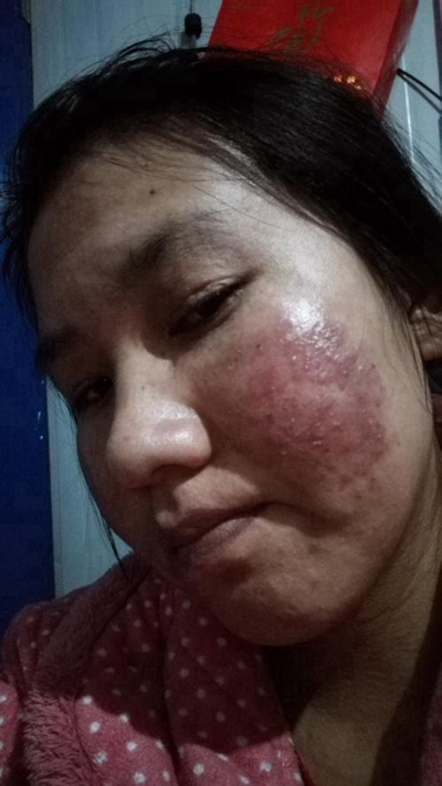 神經性皮炎的治療 (64) 