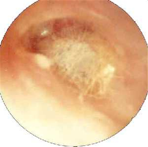 真菌性外耳道炎