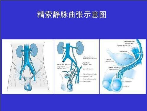 精索曲張睪丸下墜時