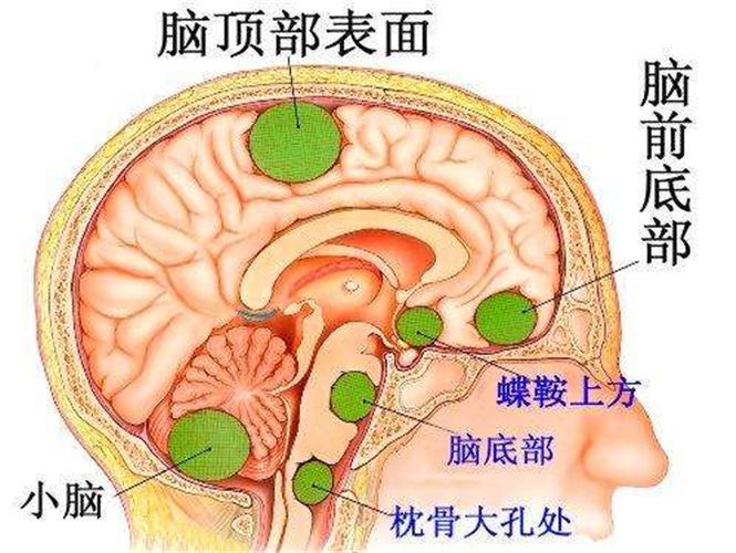 小腦腦橋腦膜瘤