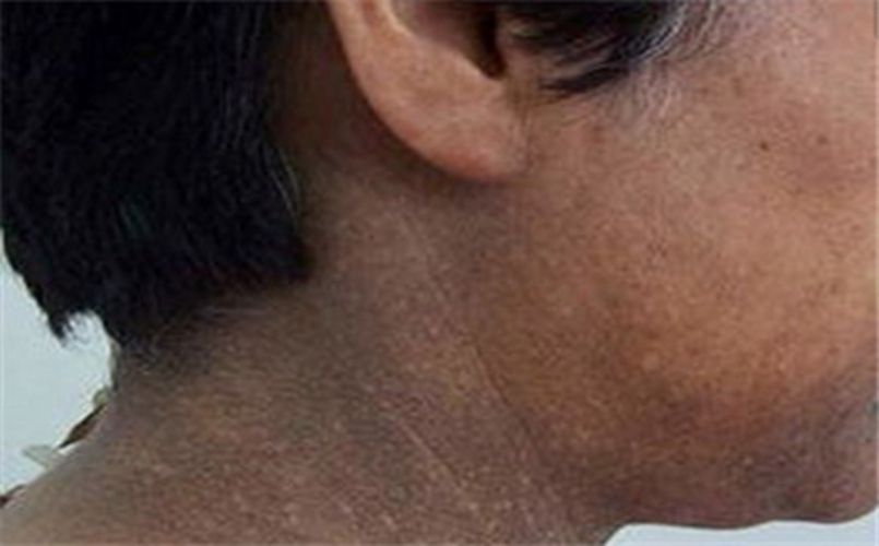 頸部皮膚黑變病嚴重