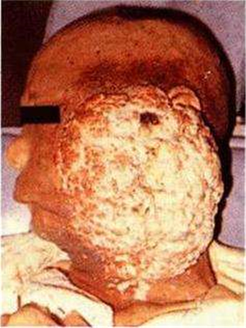 十分嚴重的頰癌