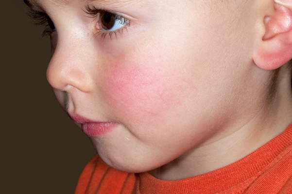 腮腺炎的症狀和