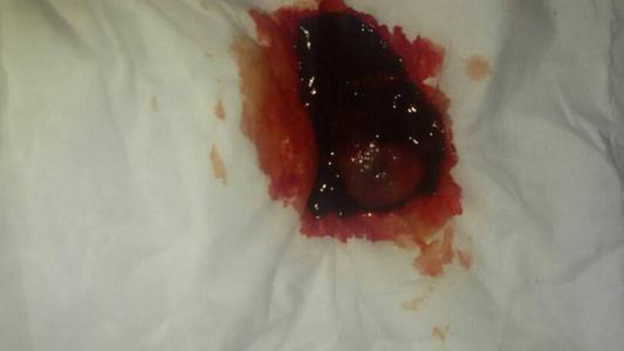 早孕藥流排出孕囊的