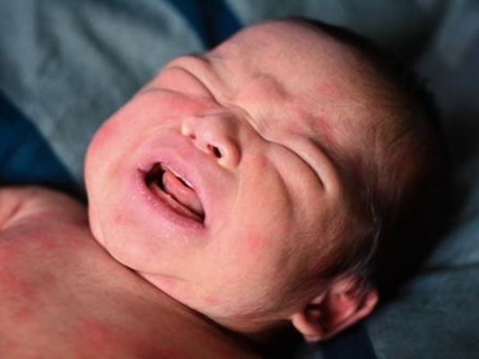 新生兒胎毒的症狀