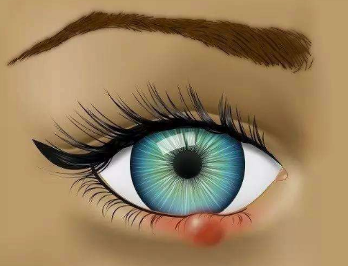 眼睛麥粒腫初期