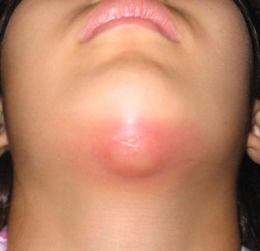 下巴皮膚腫瘤血管瘤