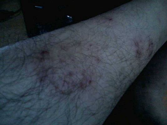 淋病的症狀 (54) 