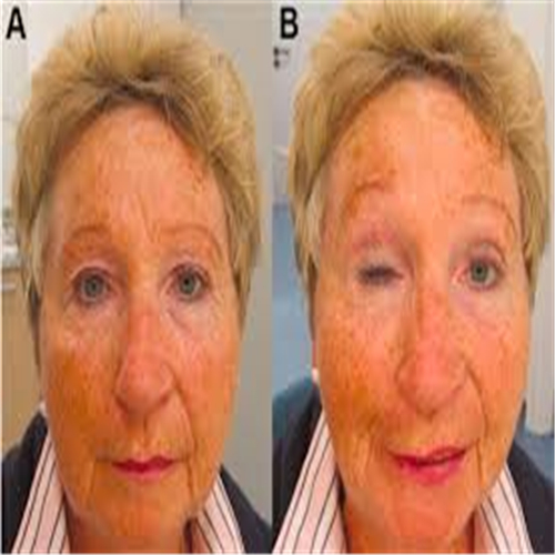 右側面肌痙攣的