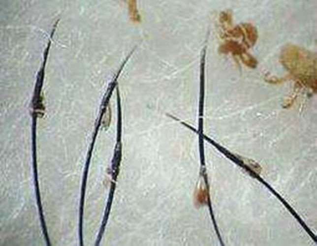 陰蝨症狀的一些