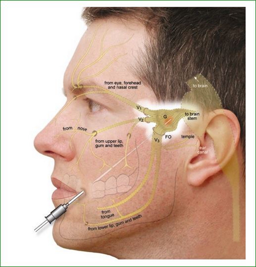 三叉神經痛周圍支封閉治療止痛