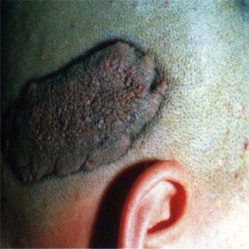 耳後皮脂腺痣