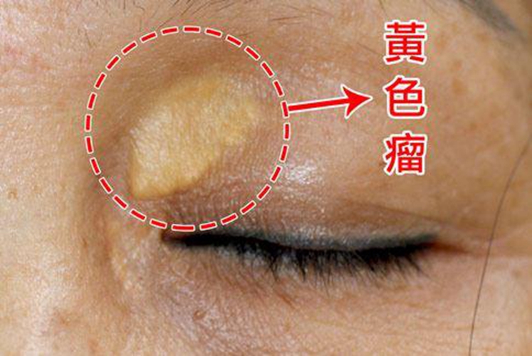 血脂異常黃色皮膚腫瘤