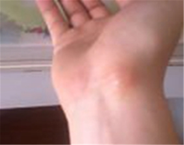 右手腕處手腕腱鞘炎