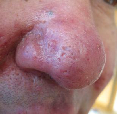 鼻子長蟎蟲症狀