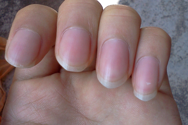 貧血指甲