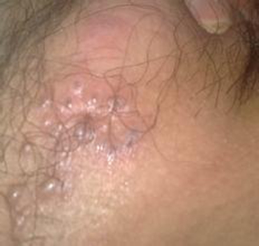 小外陰瘙癢有痘痘