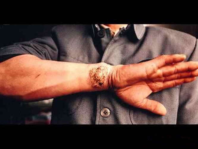 右側手臂皮膚結核病的