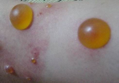 被跳蚤咬的症狀