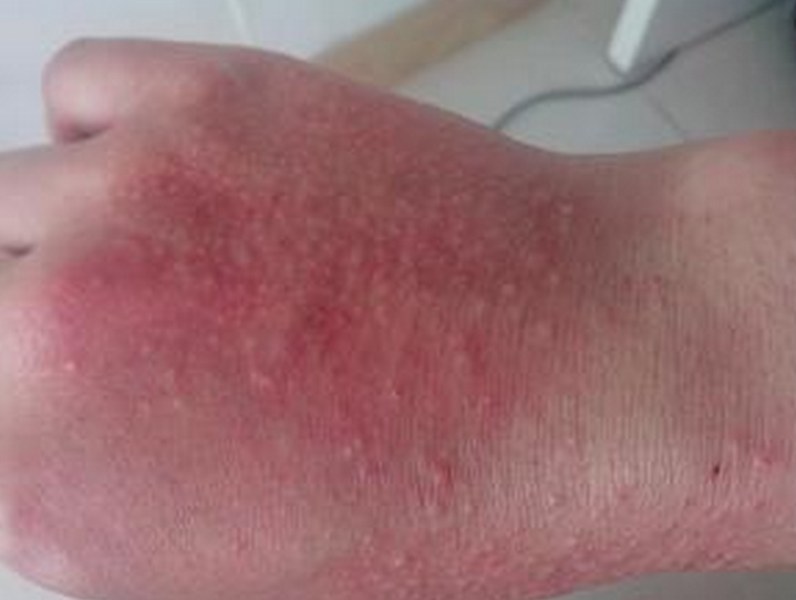 手背夏季皮炎症狀