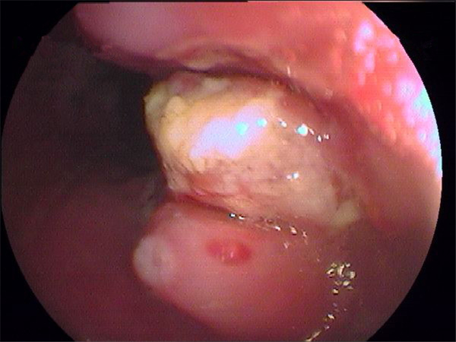 淺表型慢性胃炎怕