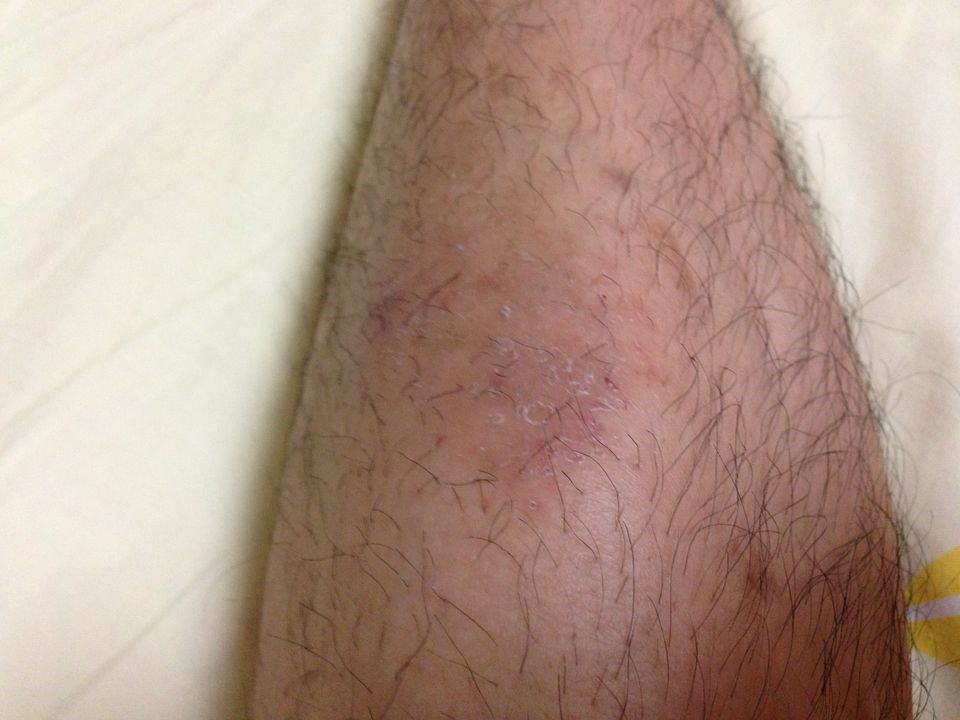 小腿的放射性皮炎