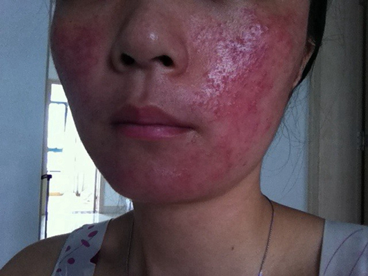 急性皮炎的症狀