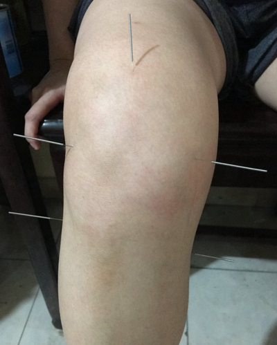 膝蓋半月板損傷症狀 (6) 