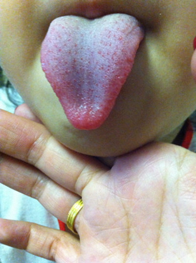 寶寶鵝口瘡 (68) 