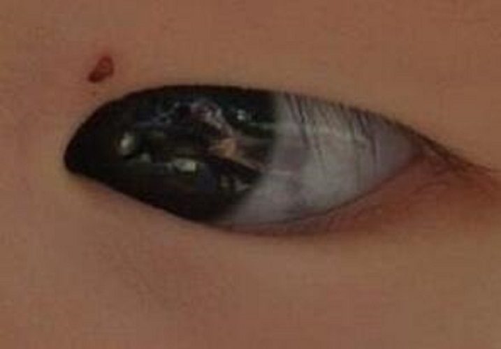 眼睛裡長太田痣的