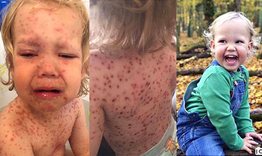 小孩天花的症狀和