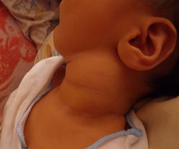小孩子甲狀腺腫大