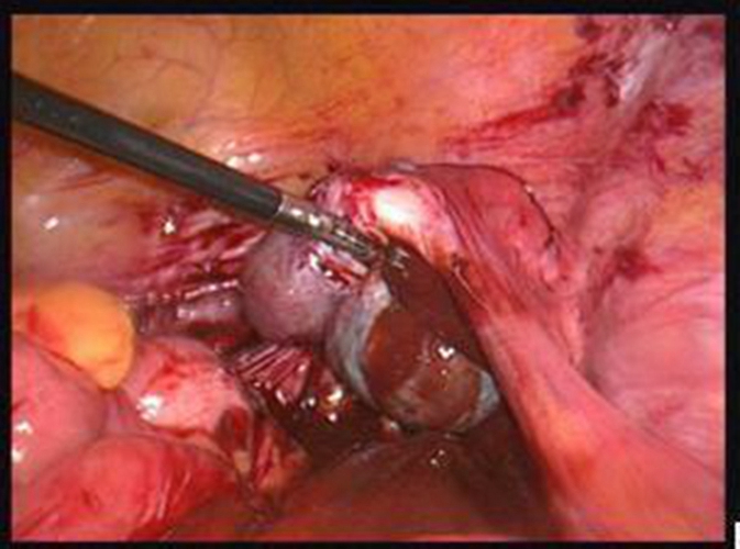 治癒巧克力囊腫