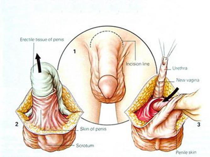 陰莖癌手術重建陰莖和尿道