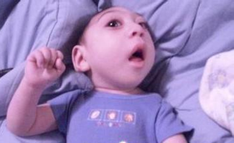 先天愚型嬰兒耳朵