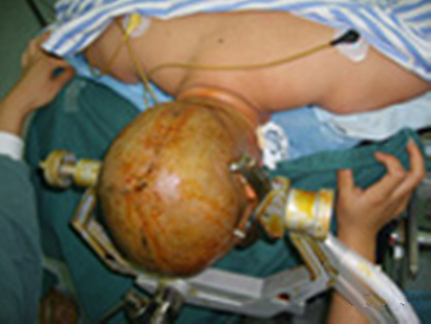 伽馬刀治療腦膜瘤