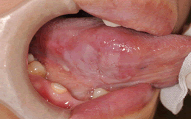 舌癌的初早期症狀