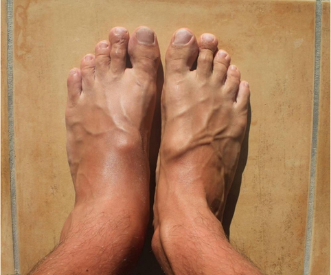 腳骨頭突出 (43) 