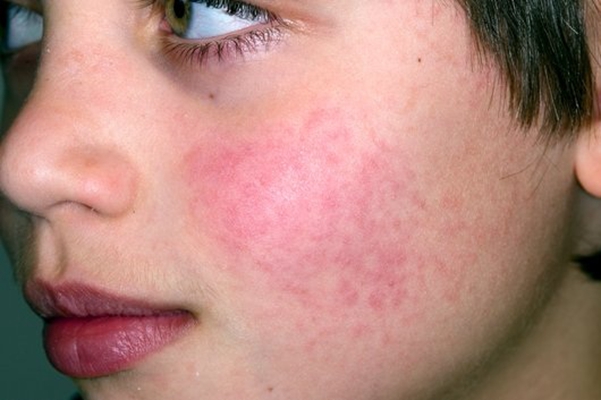 腮腺炎的症狀和